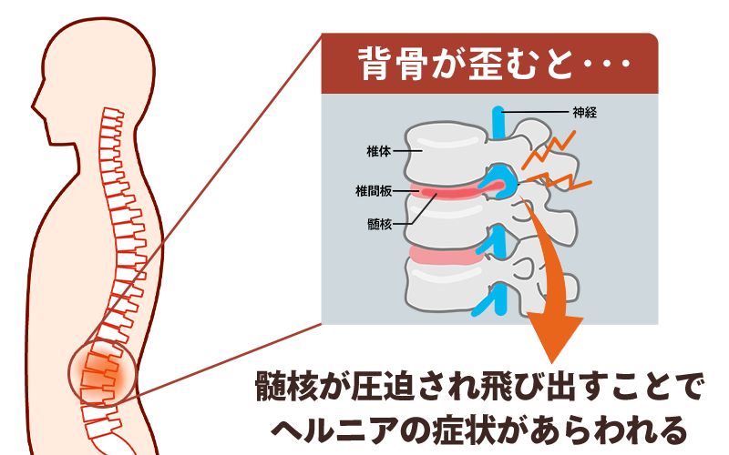 ヘルニアイメージ