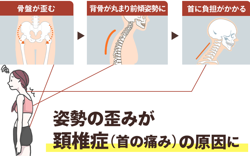 頚椎症のイメージ